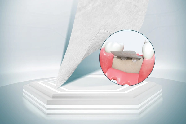 Vật liệu phẫu thuật nha khoa