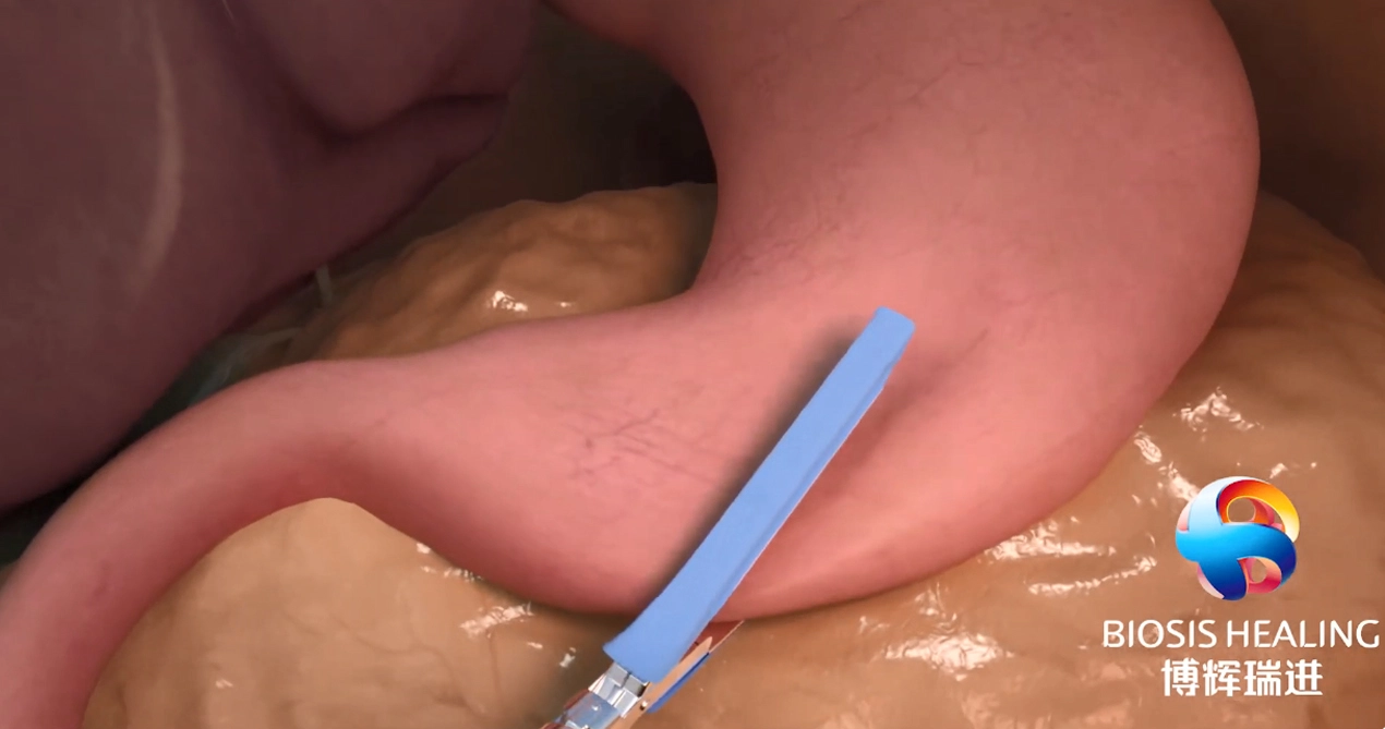 Gia cố dây Ghim (SLR) để giảm rò rỉ