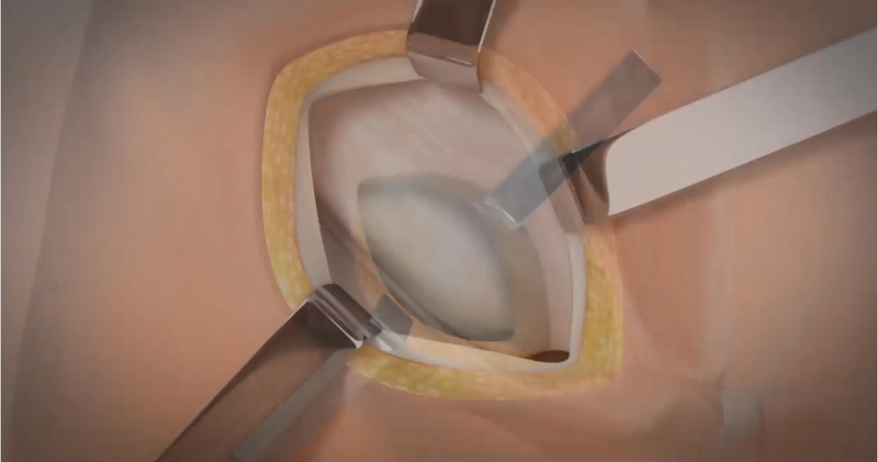 Lichtenstein sửa chữa thoát vị với lưới hấp thụ Sis