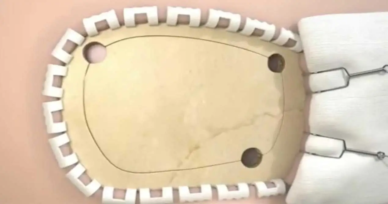 Miếng vá sửa chữa màng cứng