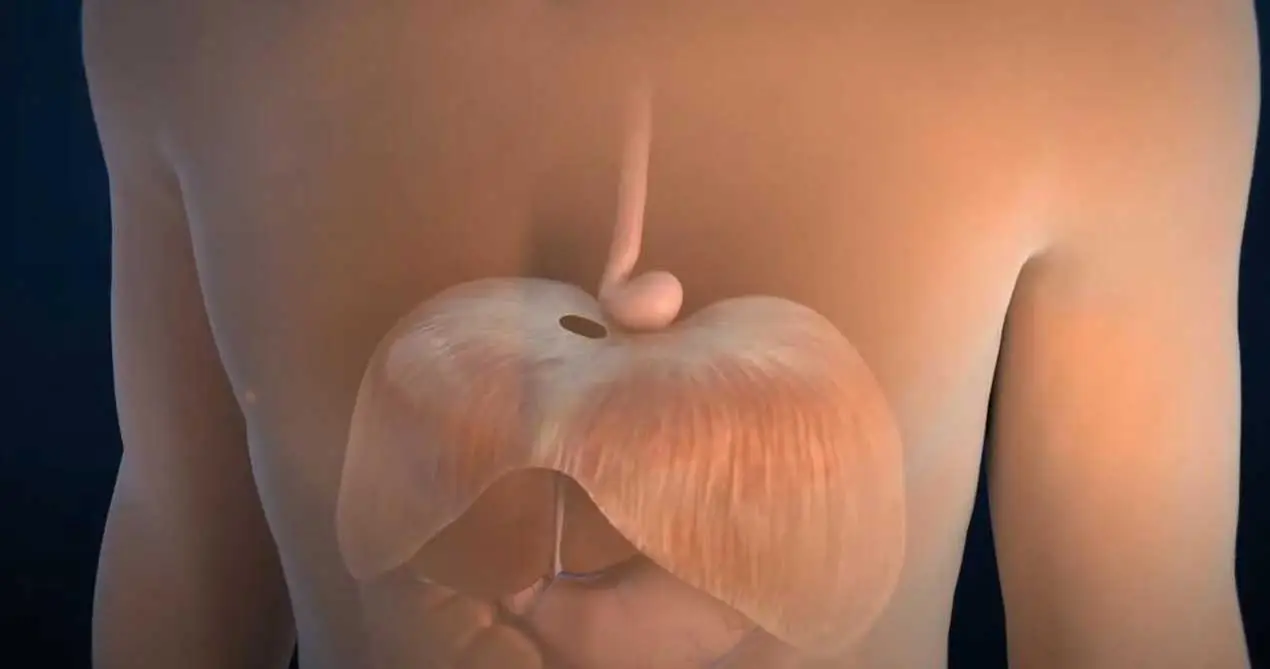 Sửa chữa thoát vị thực quản gián đoạn với lưới sinh học Sis