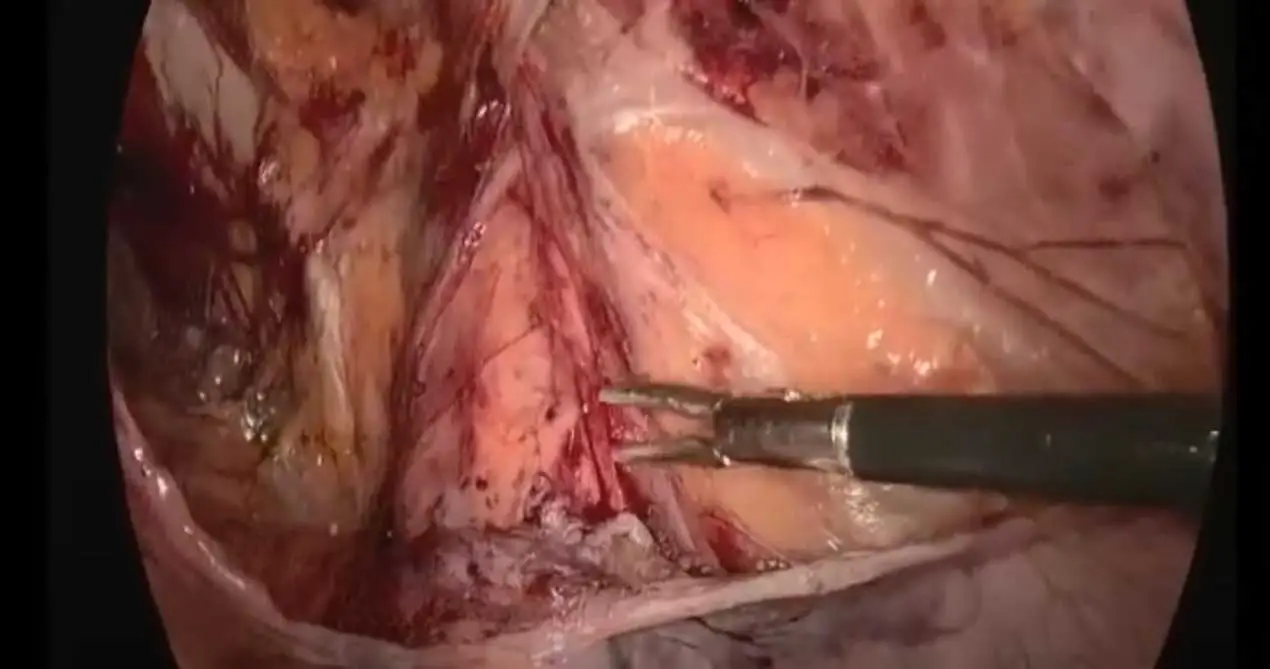 Lưới sinh học Sis phẫu thuật tapp 13x15cm để sửa chữa thoát vị