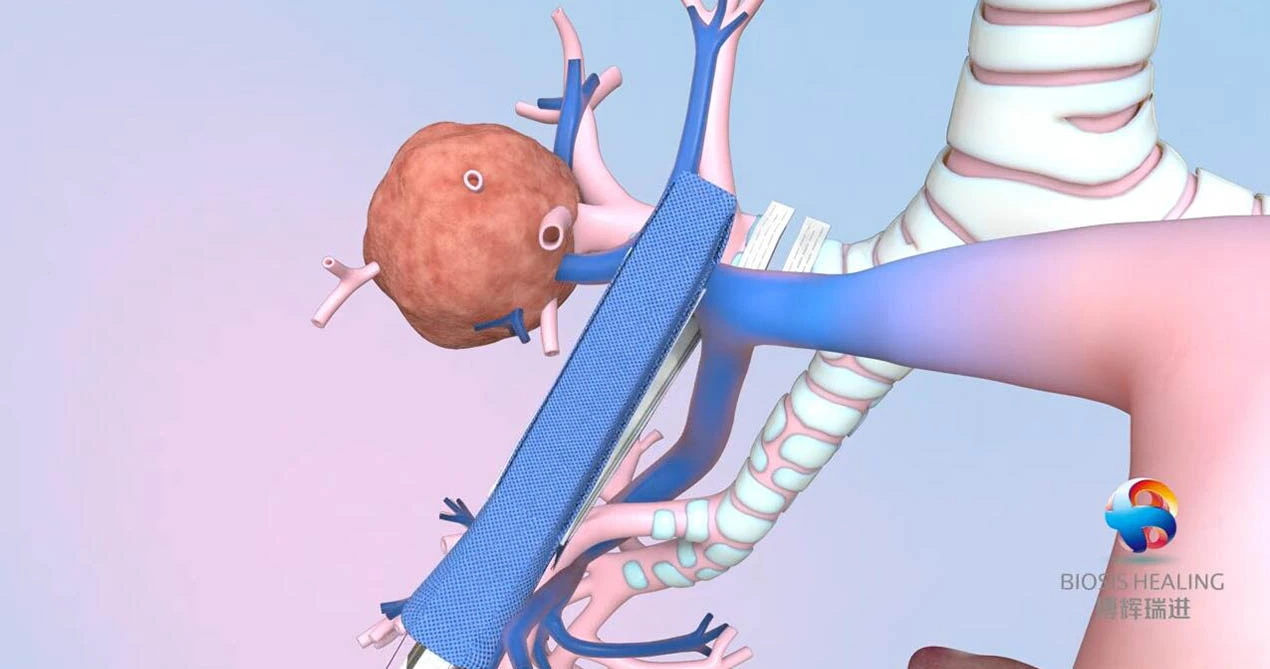 Cốt Thép dập ghim cho cắt Thùy